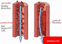 يۈرەككە كۆۋرۇك سالماسلىقىنىڭ ئاددىي رېتسىپى