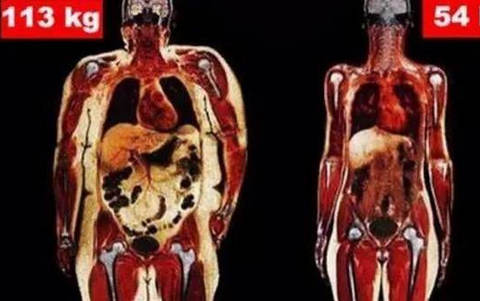 دىققەت! سېمىزلىك بىلەن مۇناسىۋەتلىك 14 خىل كېسەللىك