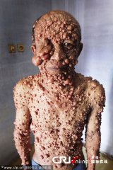 ھامىلدارلار . يۈرىكى ئاجىزلار كۆرمەڭلەر يىرگىنىشلىك رەسىم